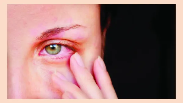 চোখের রক্তবর্ণ ধারণের কারণ ও প্রতিকার
