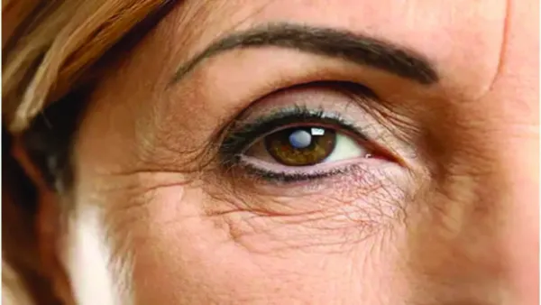 ছানি অপারেশনের পর সতর্কতা যে কারণে জরুরি