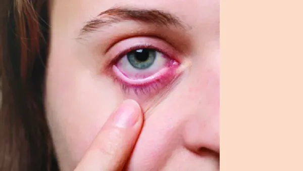 মৌসুমি অ্যালার্জিতে চোখের সুরক্ষায় করণীয়