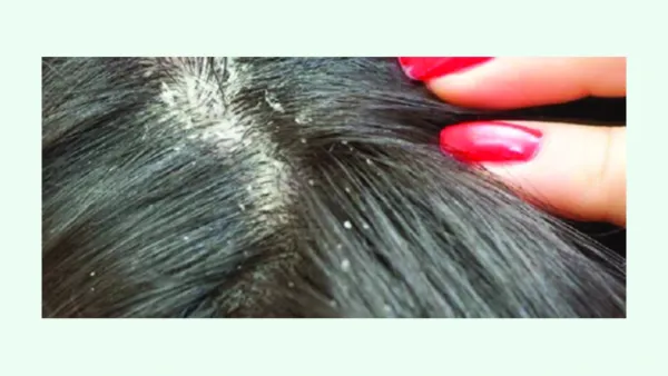 মাথার স্ক্যাল্পে খুশকি, না সেবোরিক ডার্মাটাইটিস