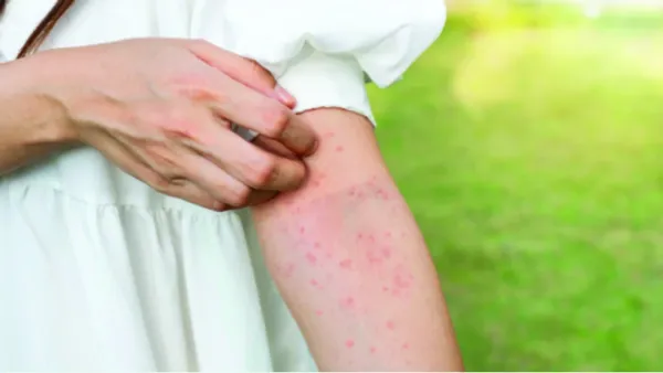 অ্যালার্জি থেকে দূরে থাকা সম্ভব