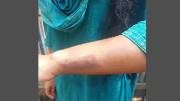 সৎমায়ের খুন্তির ছ্যাঁকায় জখম কিশোরী