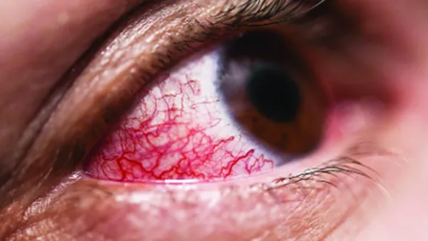 চোখের রোগ ইউভাইটিস হলে করণীয়