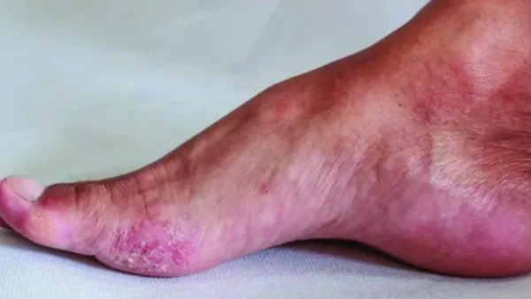 বর্ষাকালে বাড়তে পারে ত্বকের রোগ