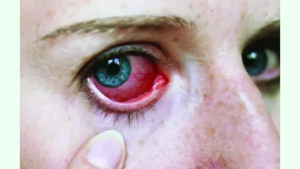 ইউভাইটিস রোগের আধুনিক চিকিৎসা