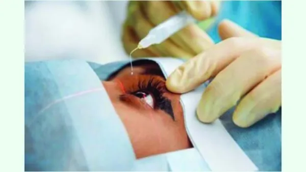 ছানি অপারেশনের পর আপনার যা করণীয়