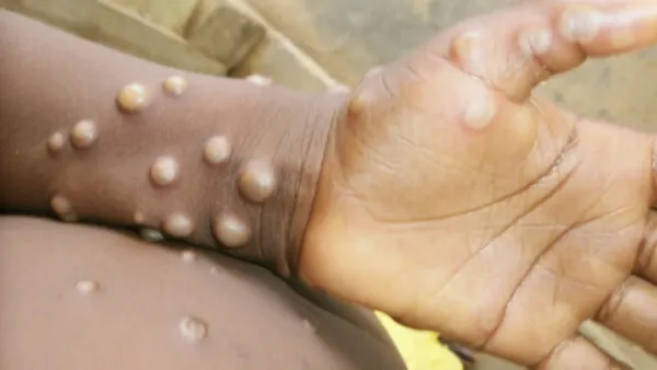 এবার থাইল্যান্ডে শনাক্ত মাঙ্কিপক্স