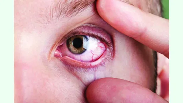 চোখের সাধারণ কিছু সমস্যায় করণীয়