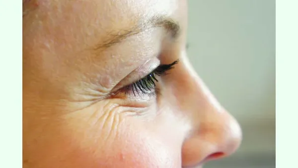 ত্বকের বলিরেখা যেভাবে কমিয়ে ফেলবেন