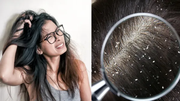 শীত আসার আগে যে কাজ করলে ভোগাবে না খুশকি