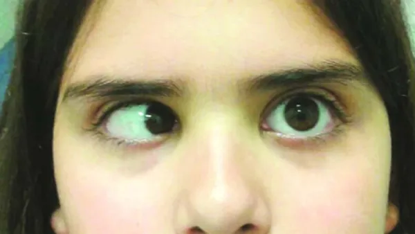 চোখের স্নায়ুজনিত রোগের সমাধান