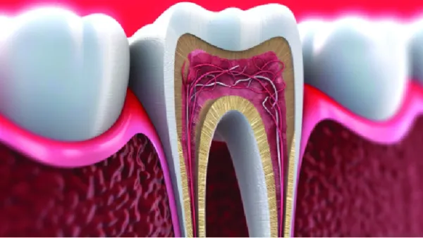 যেসব কারণে দাঁতে রুট ক্যানেল করবেন

