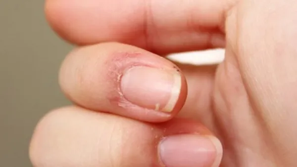 নখের সাধারণ পরিবর্তনও অবহেলার নয়