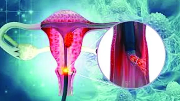 জরায়ুমুখ ক্যানসার প্রতিরোধে যা করবেন 