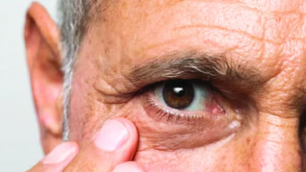 গ্লুকোমা শনাক্ত এবং এ রোগের চিকিৎসা