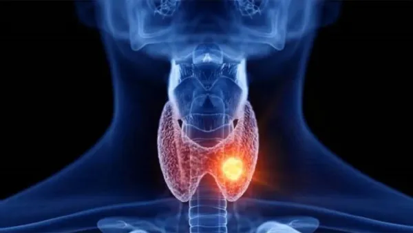 দেশে থাইরয়েড রোগী ৪ কোটি