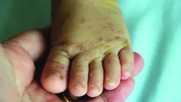 স্ক্যাবিস বা খোসপাঁচড়া খুব দ্রুতগতিতে ছড়ায়