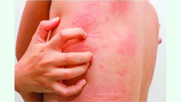 কিডনি রোগী ত্বকের চুলকানি থেকে মুক্তি পেতে যা করবেন