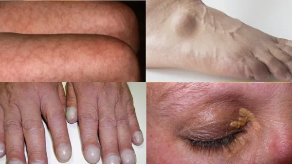 হৃদরোগের যে লক্ষণ ফুটে ওঠে ত্বক ও নখে