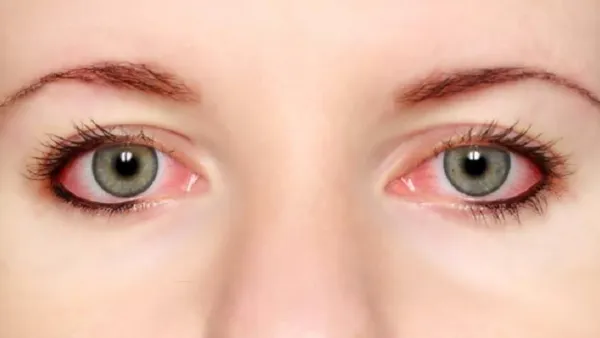 বর্ষাকালে চোখ বেশি লাল হয় কেন, করণীয় কী?