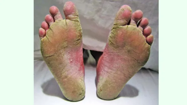 বর্ষাকালে যেসব কারণে বাড়ে ত্বকের নানা রোগ