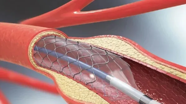 হার্টের ‘রিং’-এর দাম কমল 