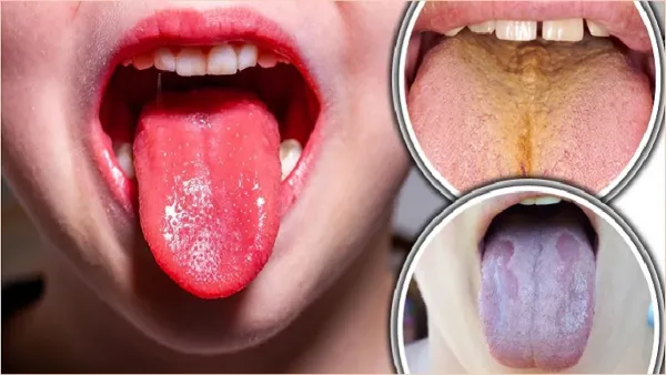 জিহ্বা দেখে স্বাস্থ্যের অবস্থা বুঝবেন যেভাবে