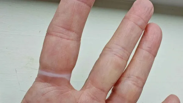 আংটি পরায় আঙ্গুলে দাগ, দূর করবেন যেভাবে