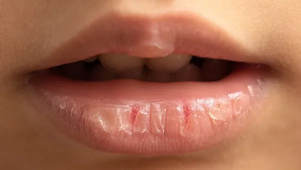 ঠোঁট ফাটা বা ঠোঁটে ঘা অবহেলা করা মোটেই ঠিক নয়