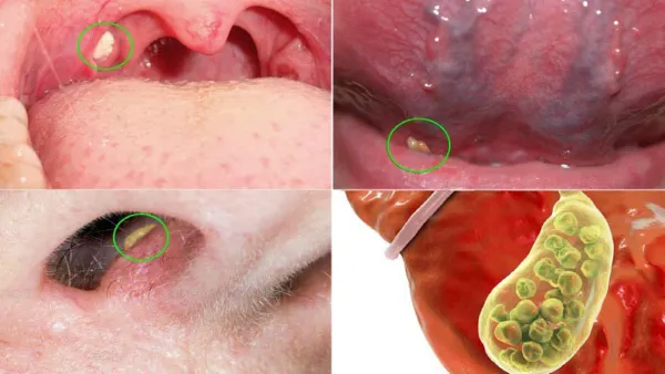 শরীরের কোন কোন অঙ্গে পাথর জমে বেশি?