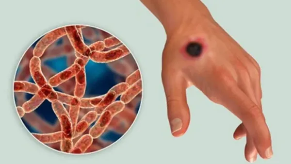 গাইবান্ধায় ৭ জনের শরীরে অ্যানথ্রাক্সের উপসর্গ