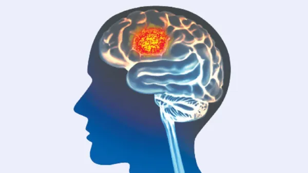 মস্তিষ্কে টিউমার মানেই কি ক্যানসার?