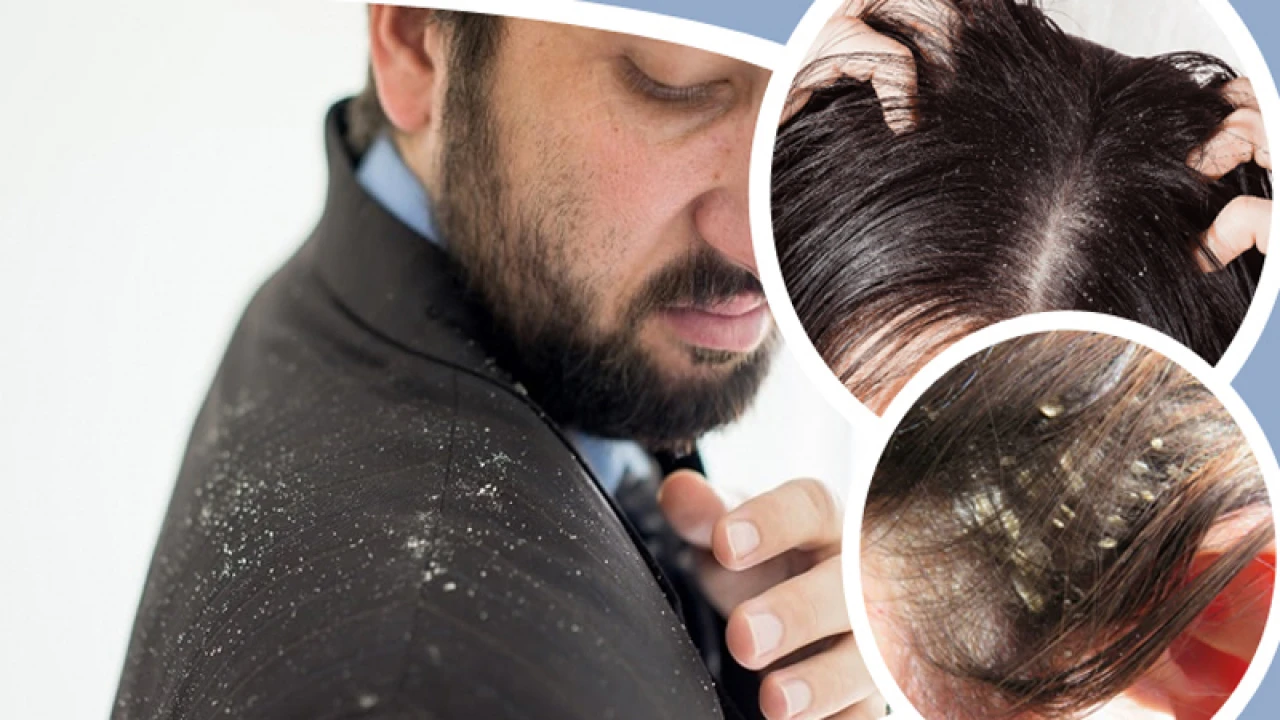 শীতে খুশকির সমস্যা সমাধান ঘরে বসেই