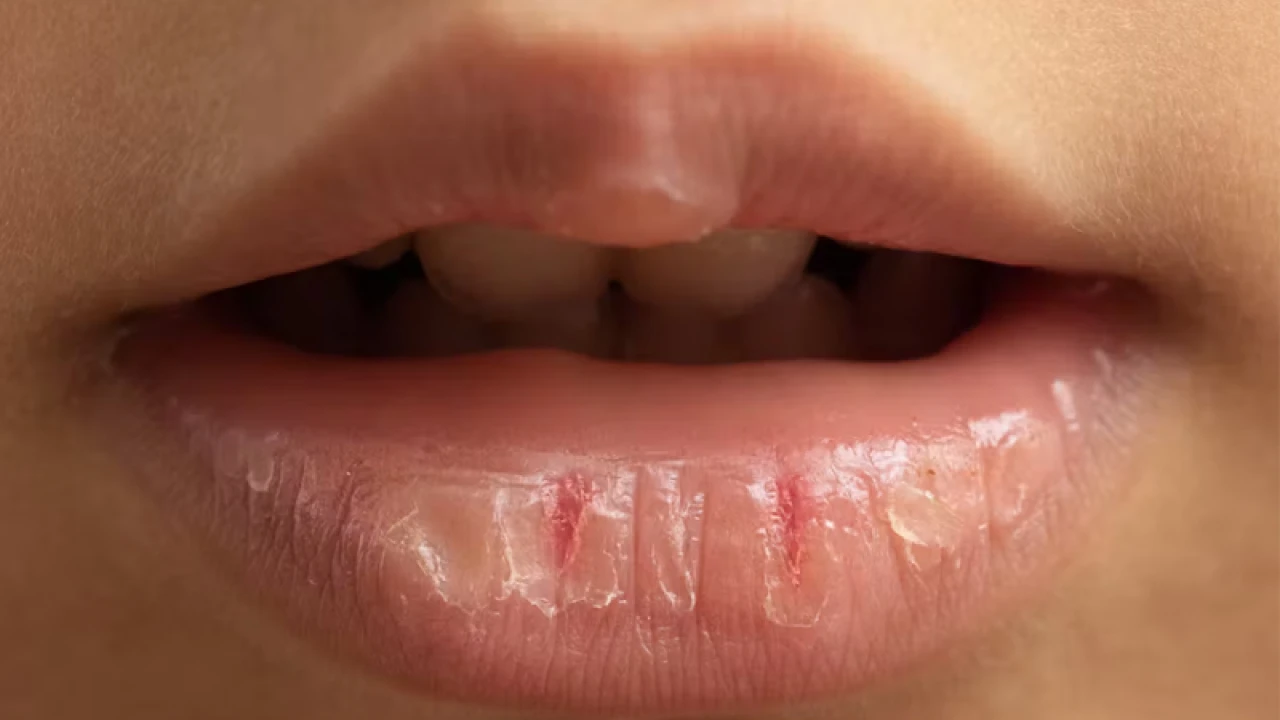 শীতে ঠোঁট ফাটা সমস্যায় করণীয়