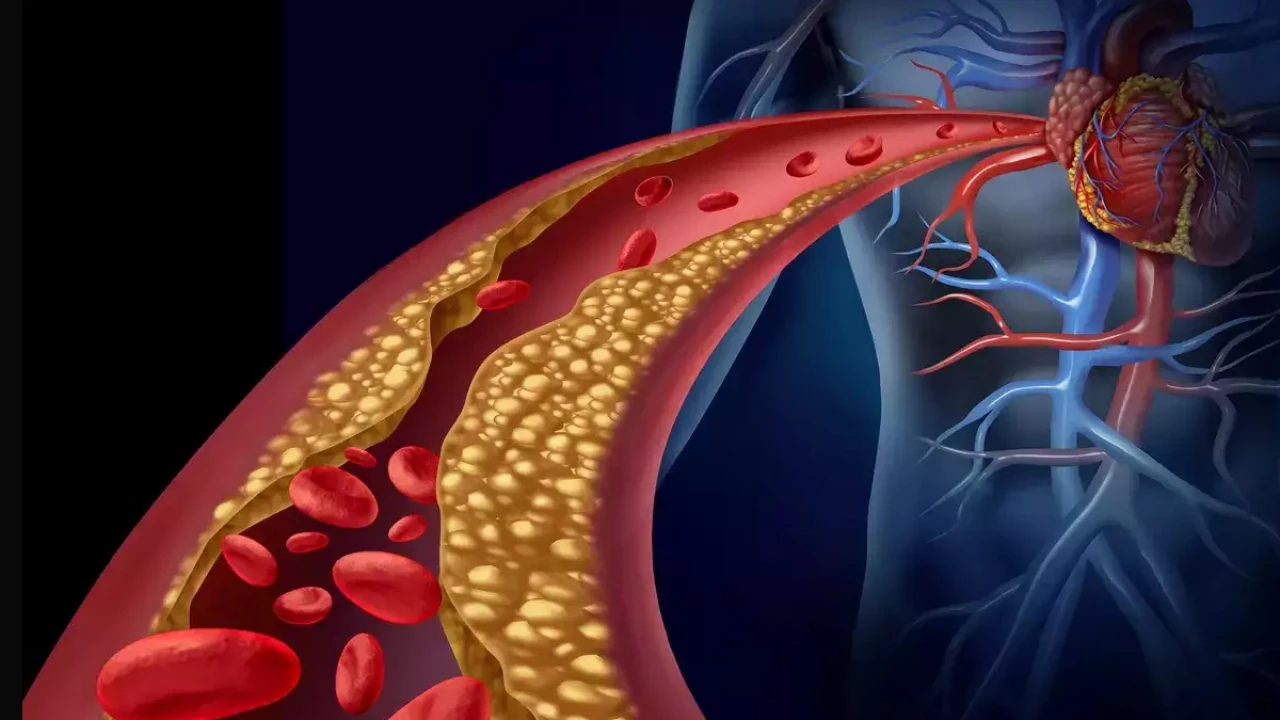 যেসব উপসর্গে বুঝবেন কোলেস্টেরল বেড়েছে