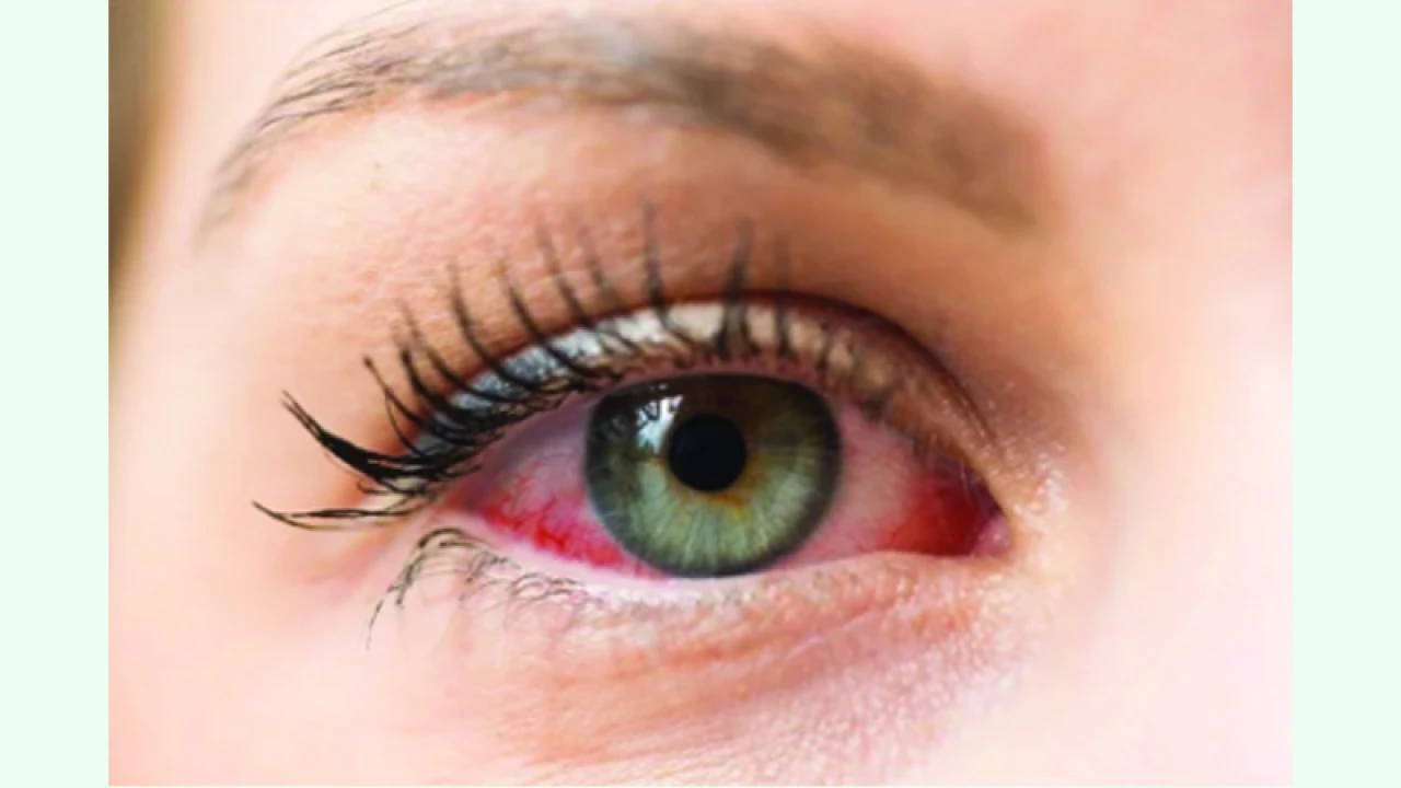 চোখের অ্যালার্জি থেকে সাবধান