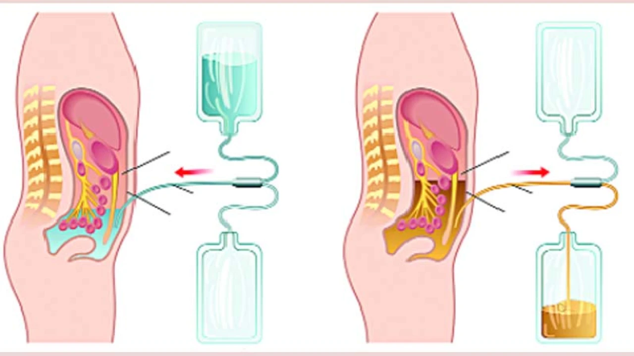 চার বছরেও আলো দেখেনি জেলা পর্যায়ে ডায়ালাইসিস