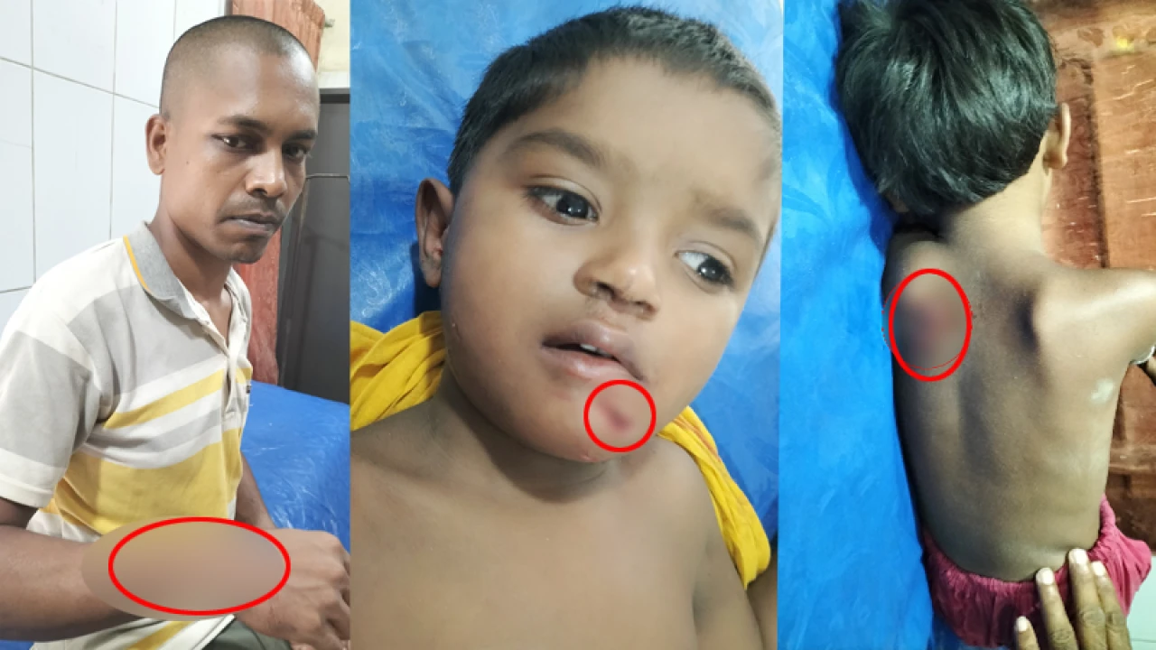 কুকুরের কামড়ে শিশুসহ ২২ জন আহত