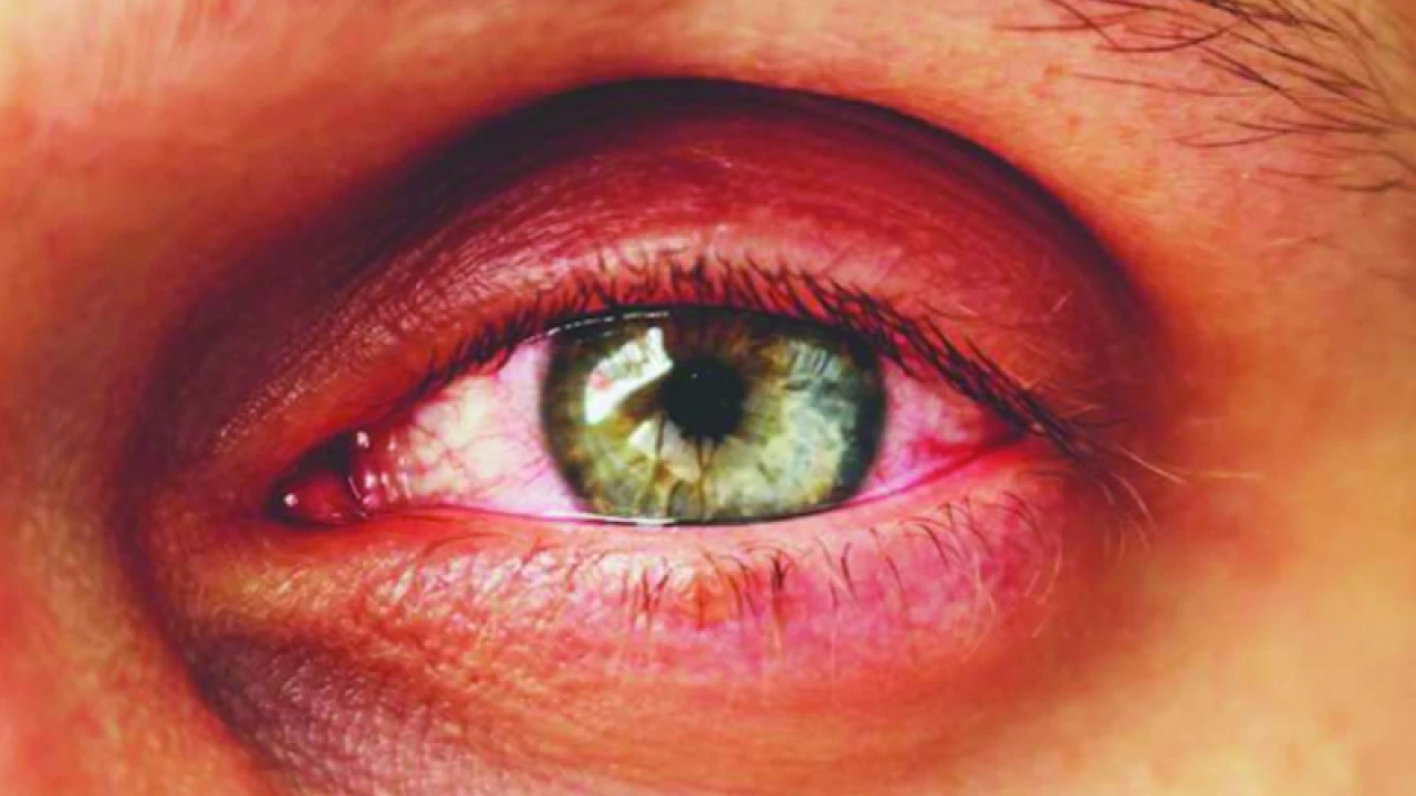 চোখের থাইরয়েডজনিত সমস্যায় করণীয়