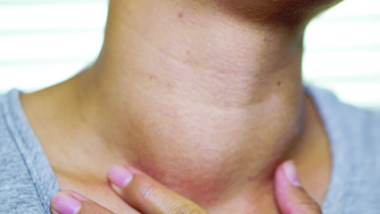 থাইরয়েড ক্যানসার প্রতিরোধে করণীয়