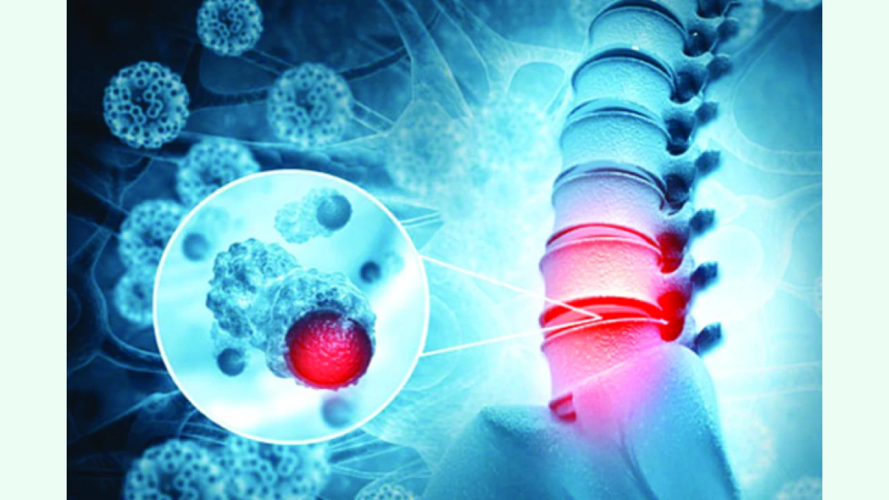 মেরুদণ্ডে টিউমার হলে বুঝবেন যেভাবে