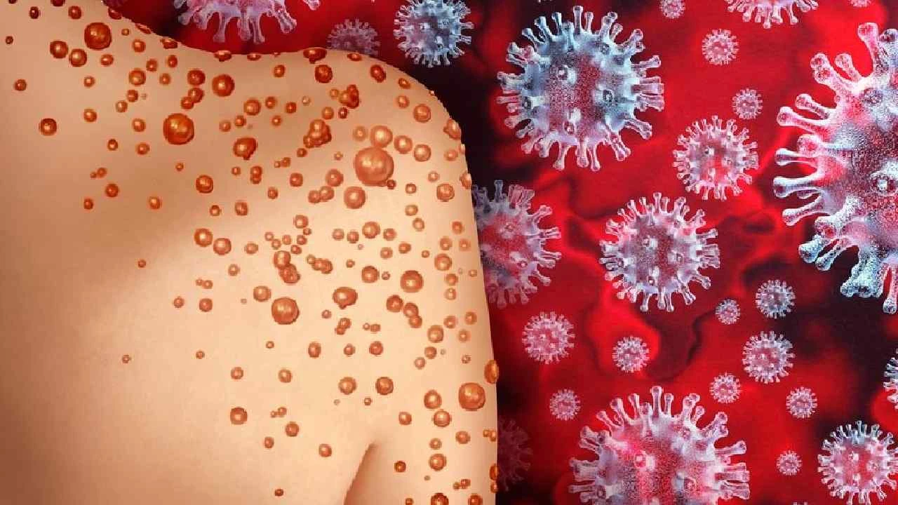 আফ্রিকার পর সুইডেনেও ‘মাঙ্কিপক্স’ শনাক্ত