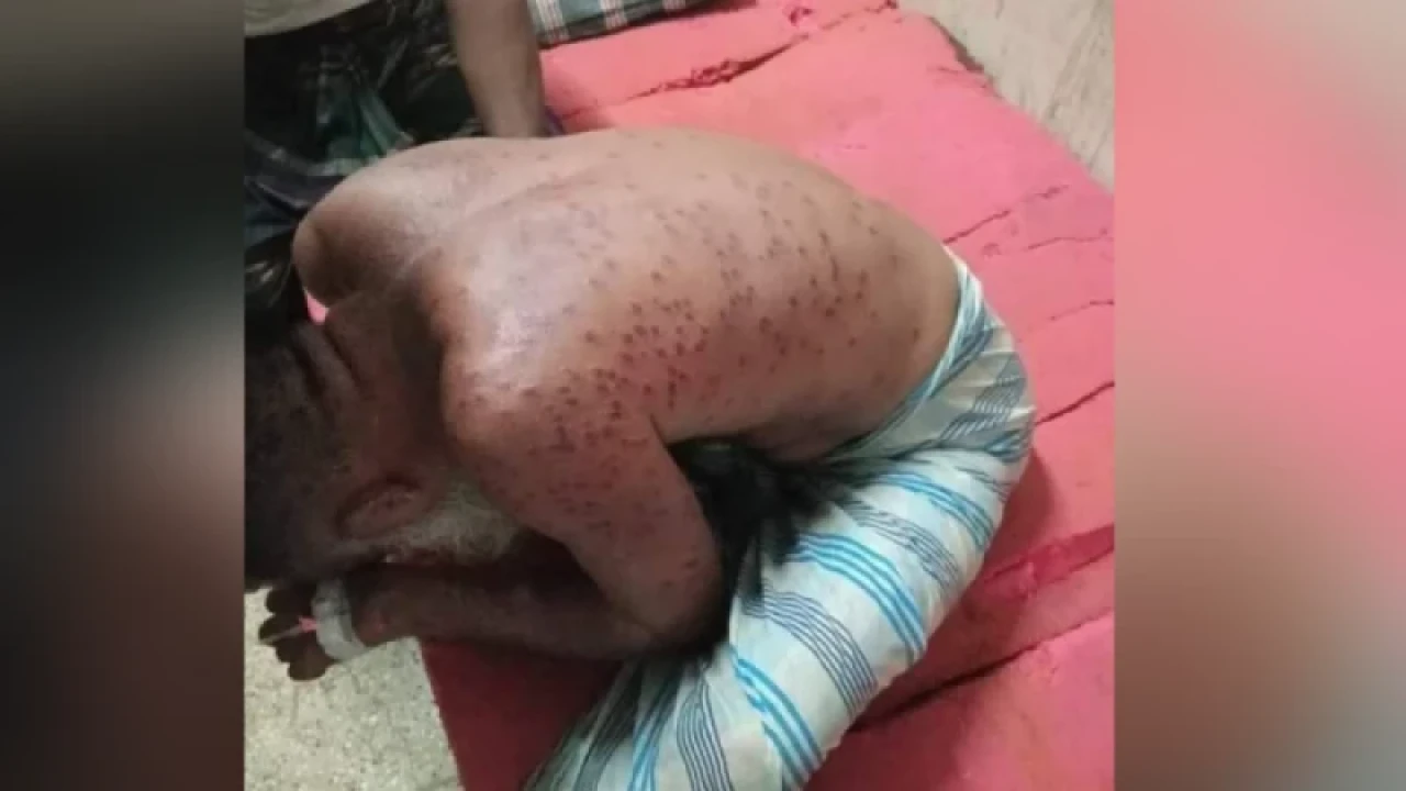 ভিমরুলের কামড়ে বাবা-মেয়ের পর চিকিৎসাধীন ছেলের মৃত্যু