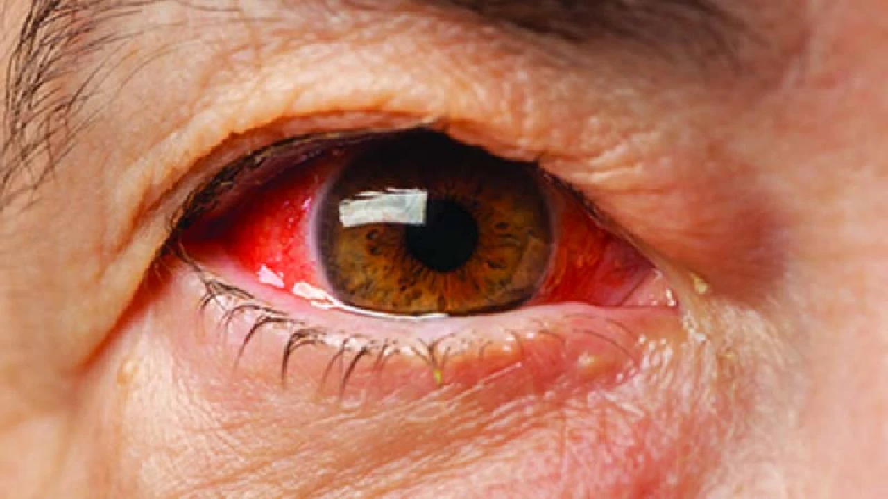 গ্লুকোমা রোগের যত কারণ এবং এটির চিকিৎসা