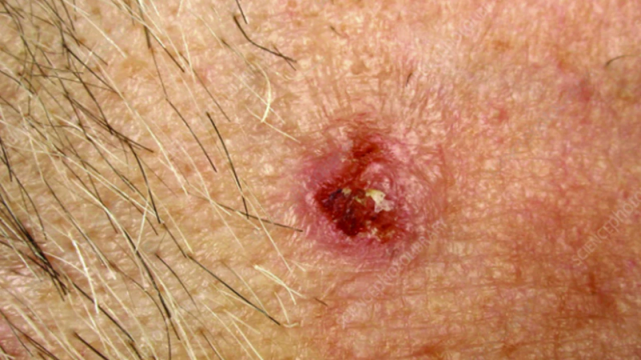 স্তন ক্যানসারের ধাপগুলো জেনে রাখুন