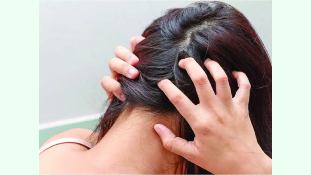 শীতকালে যেসব কারণে খুশকি বাড়ে 