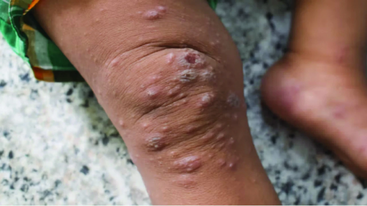 শীতেই বেশি বাড়ে চর্মরোগ স্ক্যাবিস