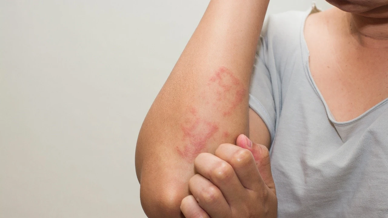 যেভাবে অ্যালার্জি থেকে দূরে থাকবেন