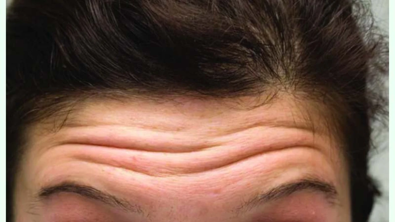 ত্বকে পড়া ভাঁজ রোধ করবেন যেভাবে