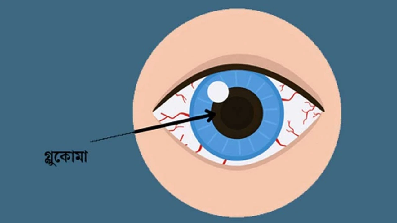 গ্লুকোমা সম্পর্কে জানুন, নিজেকে ভালো রাখুন 
